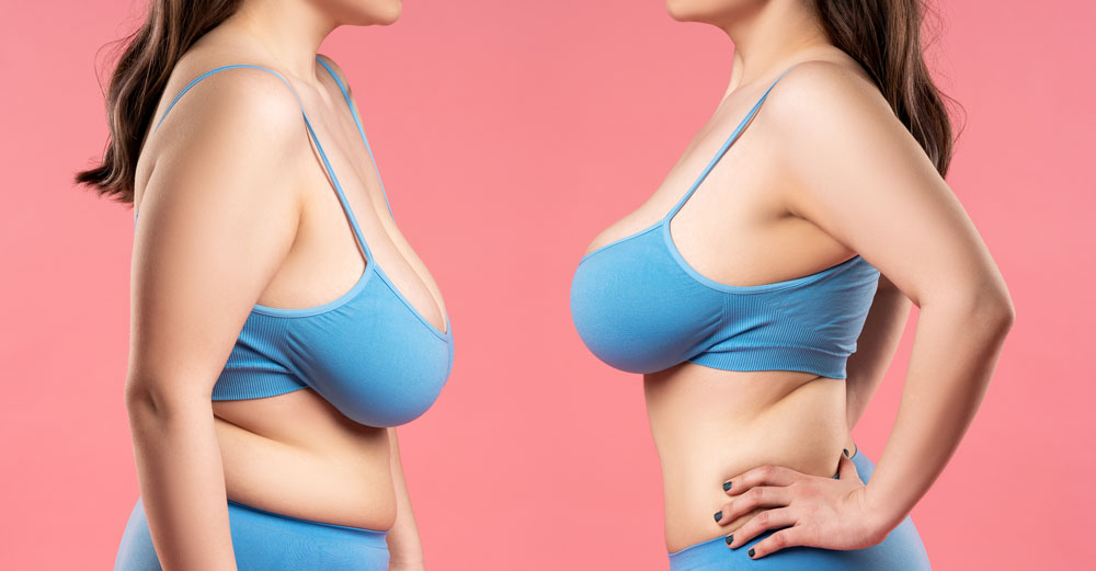 Woman’s posture has improved after Breast Reduction Surgery